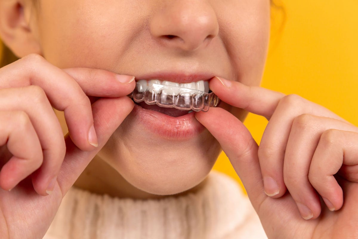 Invisalign For Kids – Smiles Orthodontics